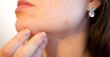 मुंहासे होने के कारण और हटाने के उपाय - Pimples home remedies hindi