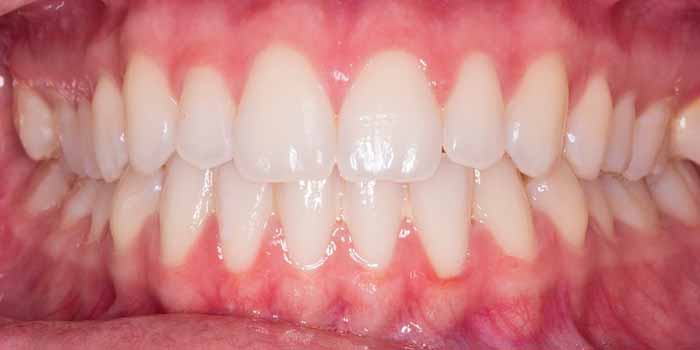 दांत का पीसना - दांतों में सेंसिटिविटी