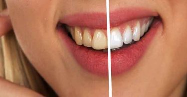 दांत में कीड़ा लगना आम बात है, लेकिन आज हम जानेंगे दांत को सफेद और चमकाने वाले फलों के बारे में, fruits for clean teeth.