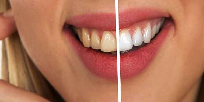 दांत में कीड़ा लगना आम बात है, लेकिन आज हम जानेंगे दांत को सफेद और चमकाने वाले फलों के बारे में, fruits for clean teeth.
