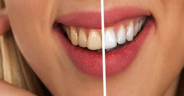 दांतों का पीलापन एक बहुत बड़ी समस्या है। इससे छुटकारा पाने लिए अपनाएं कुछ घरेलु उपचार, Home Remedies for Yellow Teeth.