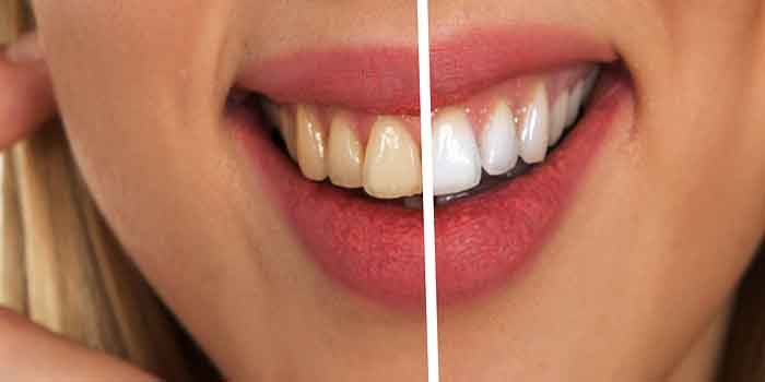 दांतों का पीलापन एक बहुत बड़ी समस्या है। इससे छुटकारा पाने लिए अपनाएं कुछ घरेलु उपचार, Home Remedies for Yellow Teeth.
