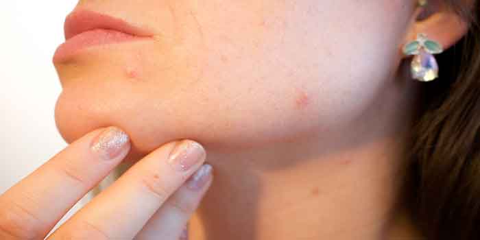 मुंहासों के कारण और दुष्प्रभाव : जाने आखिर पिम्पल या मुहासे क्यों होते हैं और कैसे इनसे निजात पा सकते हैं, pimples reasons and side effects in hindi
