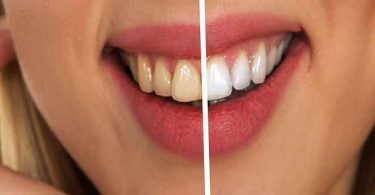 दांतों पर नमक और सरसो का तेल लगाने के फायदे 
