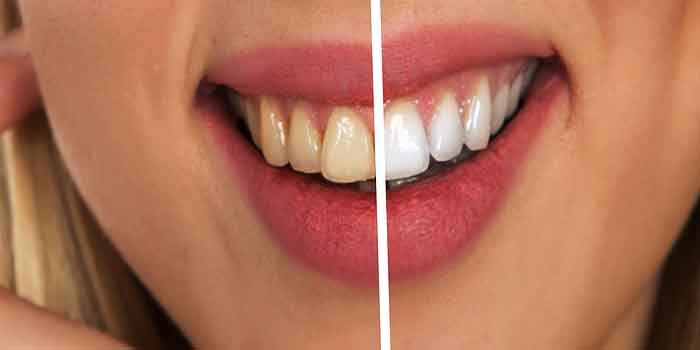 दांतों पर नमक और सरसो का तेल लगाने के फायदे 