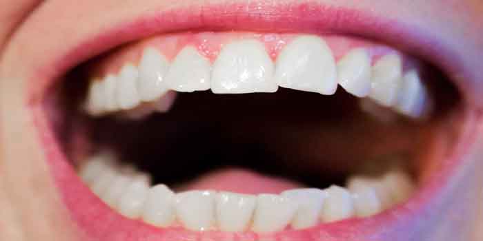 टूथ सेंसिटिविटी या दांतों में ठंडा गरम लगना
